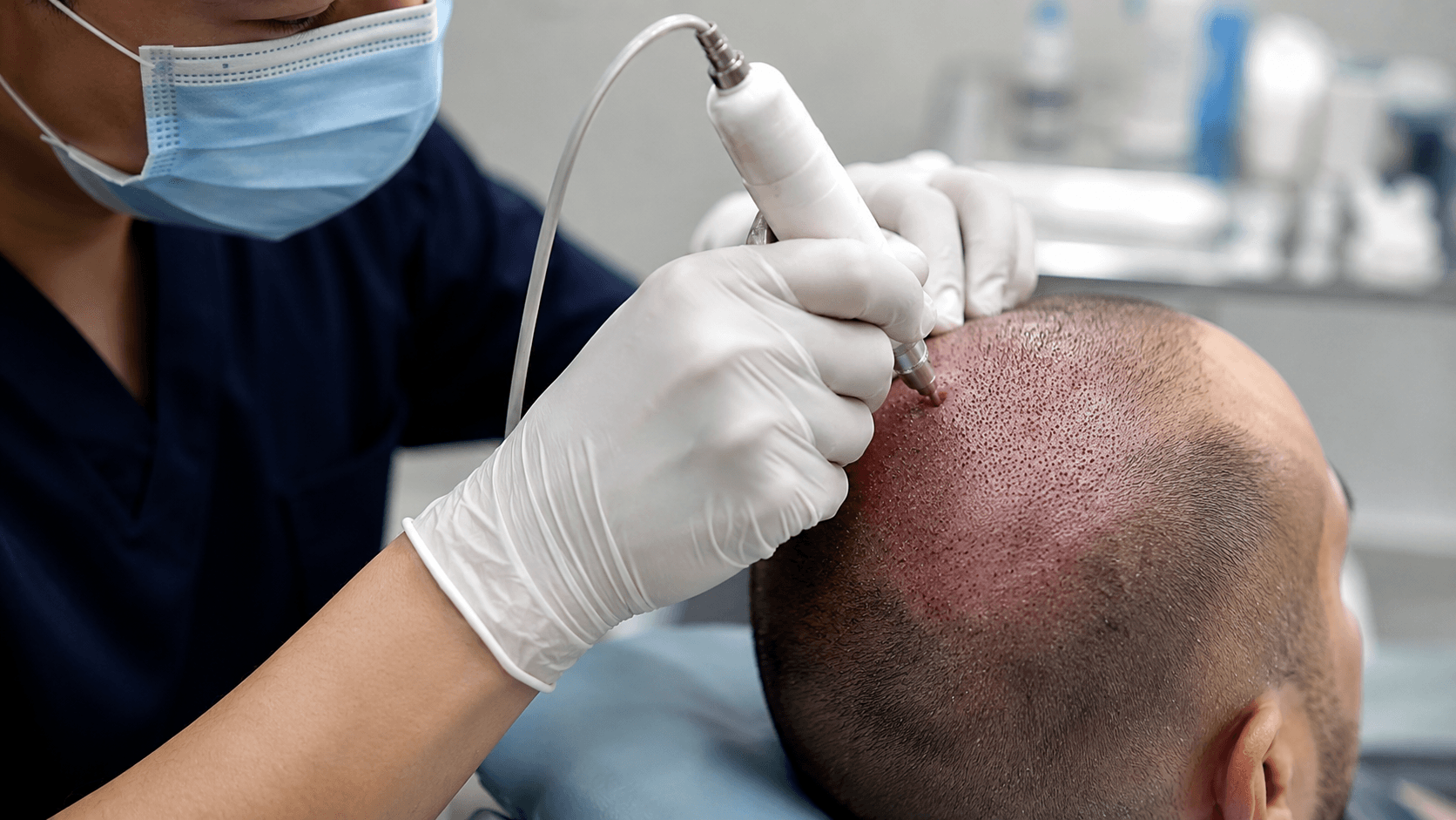 FUE Hair Transplant